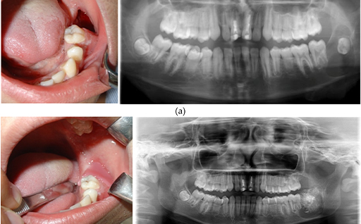 Cyst and Tumor Management