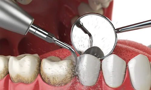 Scaling and Polishing
