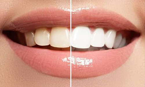 Teeth Cleaning and Whitening
