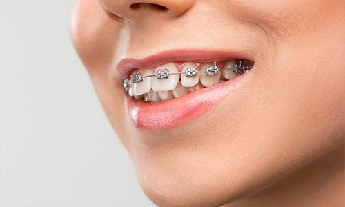 Orthodontic Braces