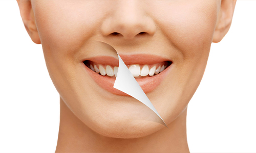 Smile Designing