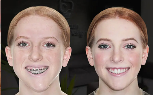 Jaw Fracture Repair